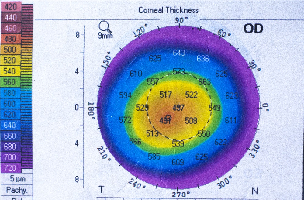 what is Corneal Ectasia