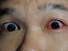 bloodshot eyes after drinking